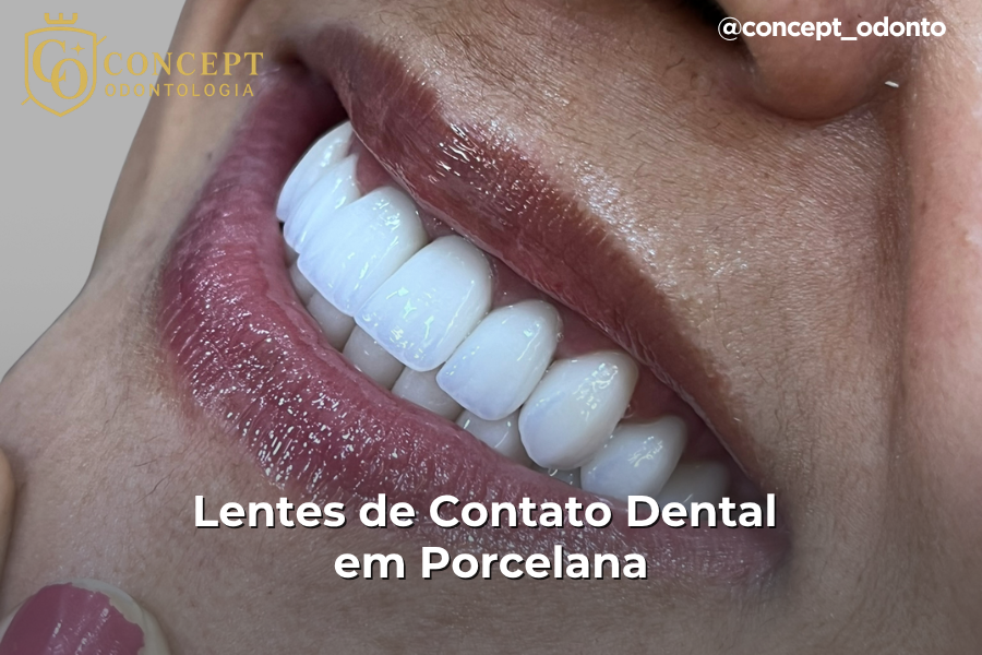 lentes de contato dental