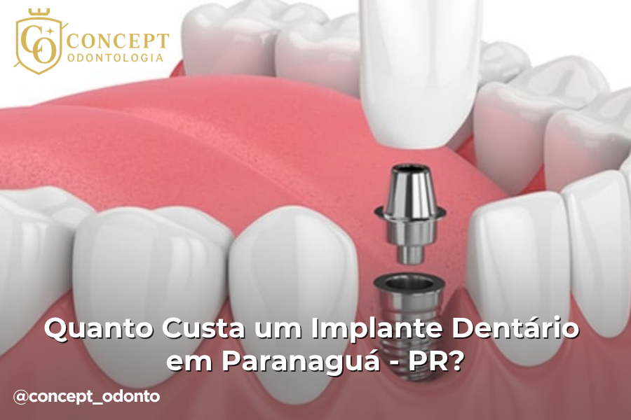 implante dentario paranagua