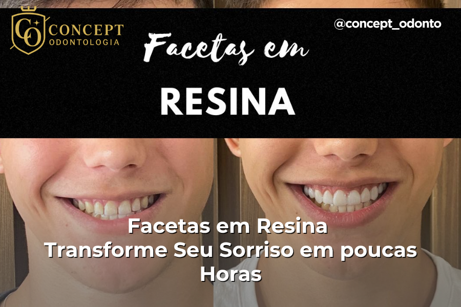 facetas em resina