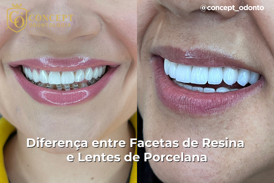 facetas resina lentes porcelana